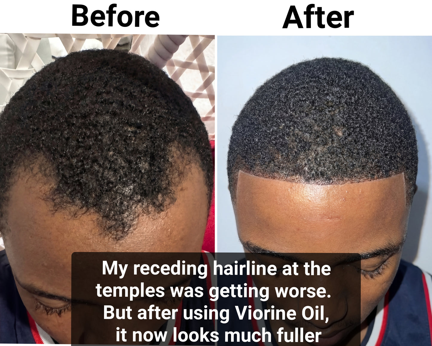 Viorine Advanced Batana Hair Regrowth Therapy